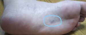 左第5中足骨骨折の足の裏（内出血）