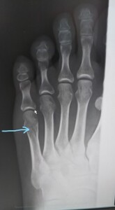 左第5中足骨骨折（足の骨折）１４日